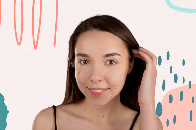 WHAT TO TRY WHEN YOUR ACNE WON’T CLEAR UP